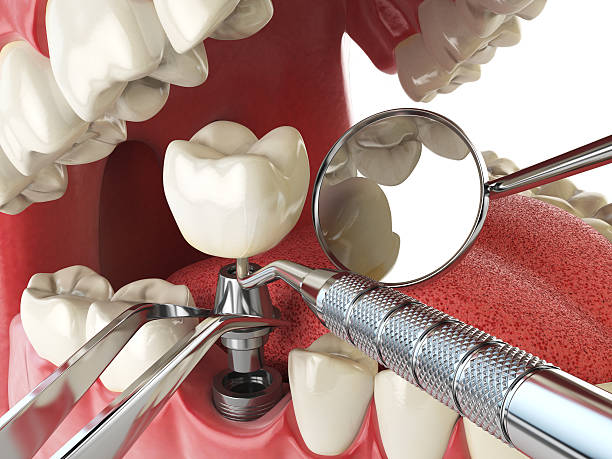 Best Dental Abscess Treatment in Marshville, NC